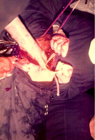 Sejarah Bedah Torak thoractomy under local anaesthesia 25