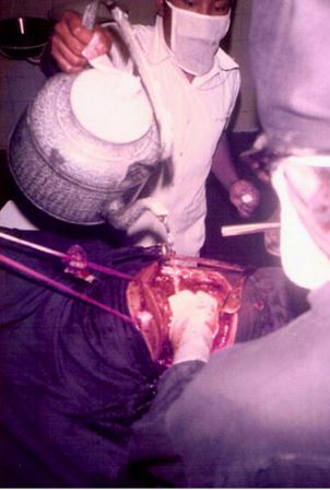 Sejarah Bedah Torak thoractomy under local anaesthesia 26